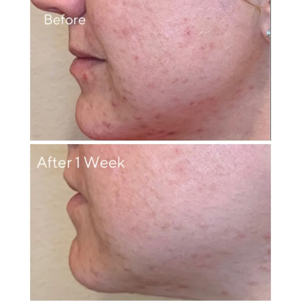 Murad AHA/BHA/Retinoid Daily Clarifying Peel 95ml